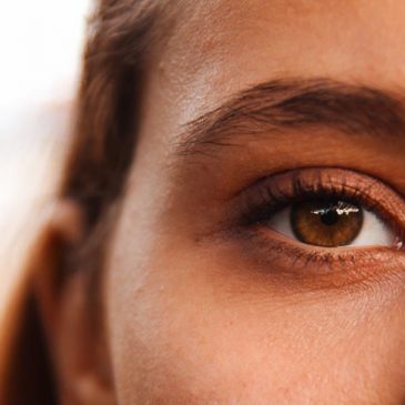 A woman's brown eyes, with severely dry skin.