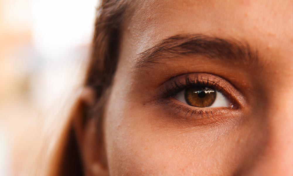 A woman's brown eyes, with severely dry skin.