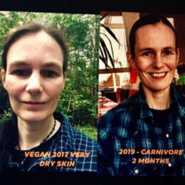 Corina before after carnivore diet results nutrient deficiency